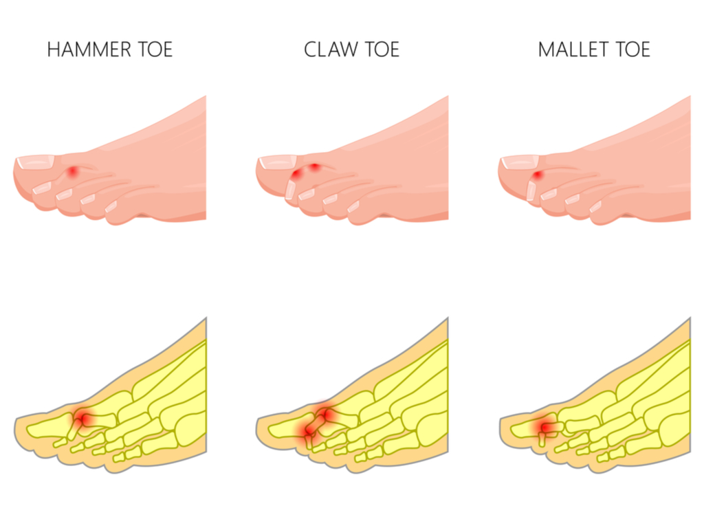 What are corns and hammer, claw, and mallet toes?