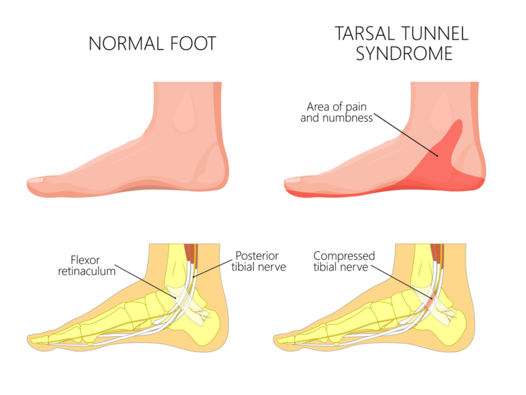 Heel Spur vs. Plantar Fasciitis: What's the Difference and How to Diagnose?  | Modern Foot & Ankle